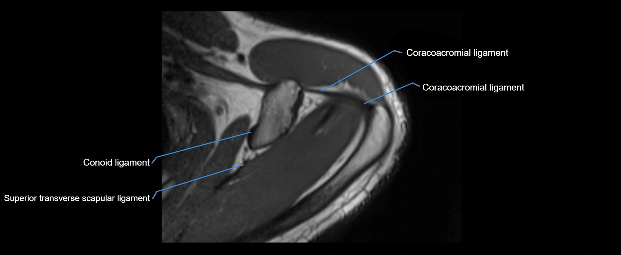 shoulder ligaments axial 3d 3t mri image-img-00005-00035.webp